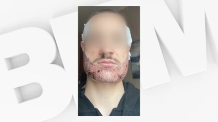 un étudiant se suicide après une greffe de barbe ratée en Turquie