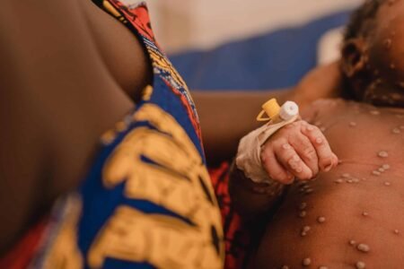 RDC : les enfants menacés par la recrudescence de Mpox