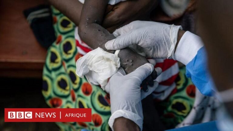 RD Congo mpox : La course aux vaccins dans le pays
