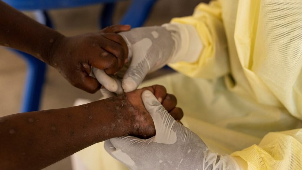 De la RDC à la Côte d’Ivoire, l’épidémie de variole du singe inquiète l’OMS et l’UA