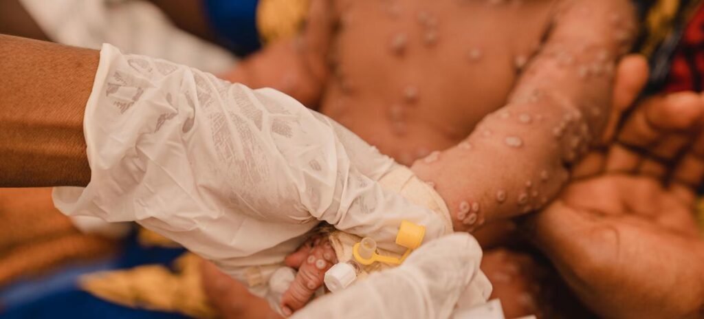 RDC: Apparition de Foyers de Maladies Infectieus à la suite