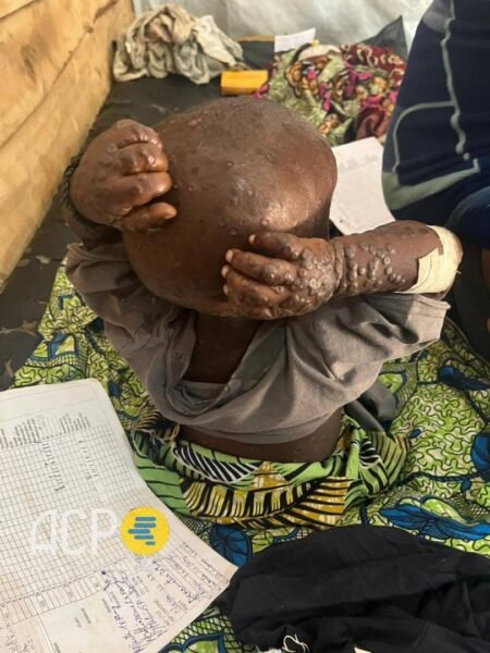 Masisi : recrudescence des cas de Mpox dans le secteur de Katoyi