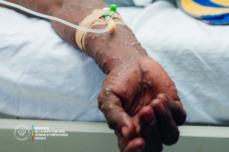 La Province de Lomami en Proie à 3 Épidémes: Mpox, Rougeole, Choléra